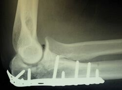 Elbow Fracture, Ulna Platting, Olecranon ORIF Platting surgery,