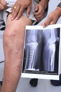 Upper end tibia Fracture surgery, ORIF Tibia Platting, Knee fracture surgery, Intra articular tibia fracture treatment with surgery by Dr Hardik Shah, Gurukul Road