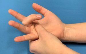 Trigger finger, Trigger Thumb, Stenosing Tenosynovitis
