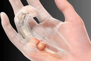 Trigger Finger, stenosing tenosynovitis, finger pain