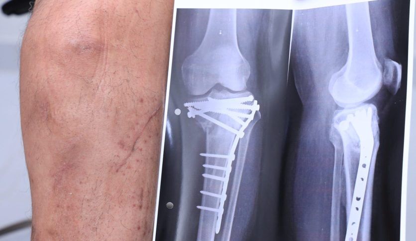 Upper end tibia Fracture surgery, ORIF Tibia Platting, Knee fracture surgery, Intra articular tibia fracture treatment with surgery by Dr Hardik Shah, Gurukul Road