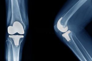 Knee Joint Replacement Surgery TKR THR By Dr Hardik Shah near Gurukul Road Thaltej Shilaj Ahmedabad