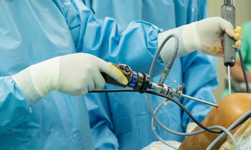 shoulder arthroscopy shoulder stiffness rotator cuff injury frozen shoulder